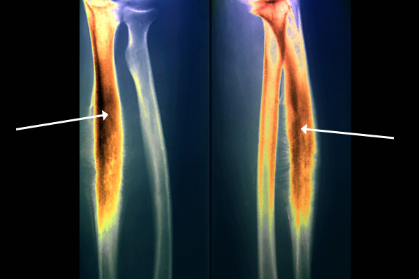 sarcoma-ewing detik-bola